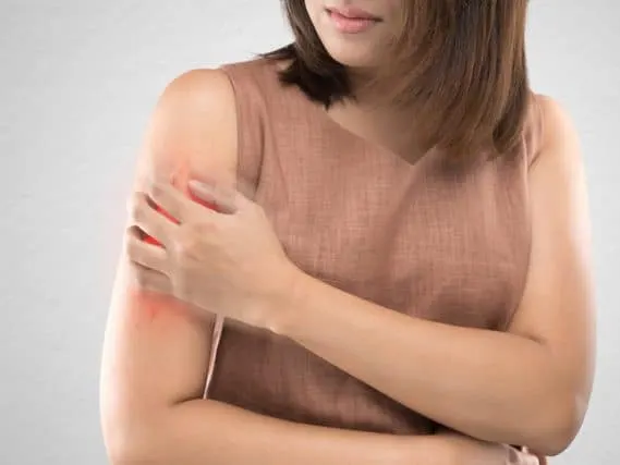 A woman in a brown top scratching a red patch on her upper arm