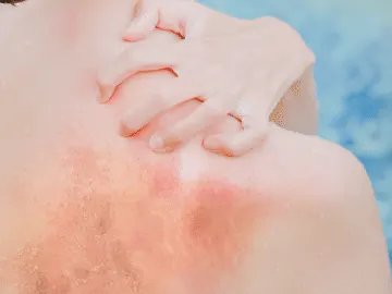A sunburned back and shoulder beside blue swimming-pool water