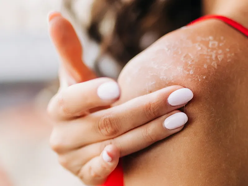 A woman's shoulder with dry, peeling, sun-damaged skin and a hand resting on it