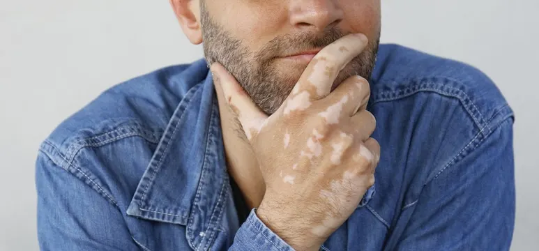 A man in a denim shirt resting his chin on his hand, with pale vitiligo patches on his hand and neck