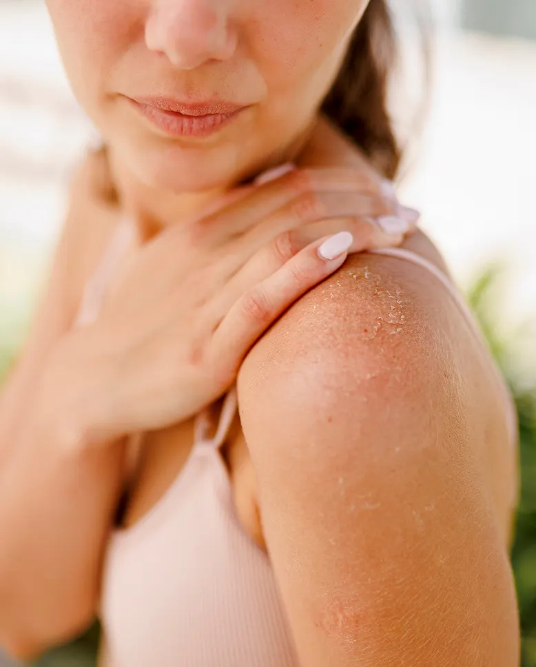 A woman's bare shoulder, red and irritated from sun exposure, with her hand resting on it
