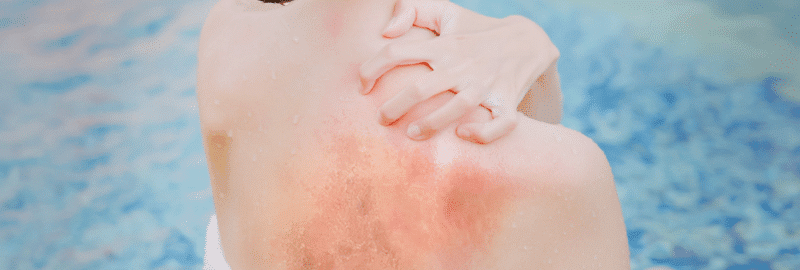 A sunburned back and shoulder beside blue swimming-pool water
