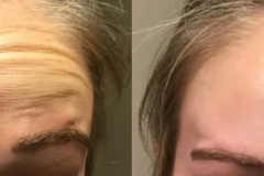 botox4