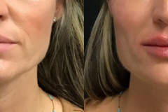 fillers4