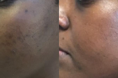 microneedling3