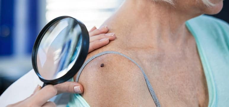 dermatologist inspecting a suspicious mole on a patient's shoulder as part of a skin cancer exam