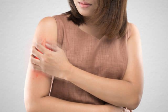 woman with psoriasis