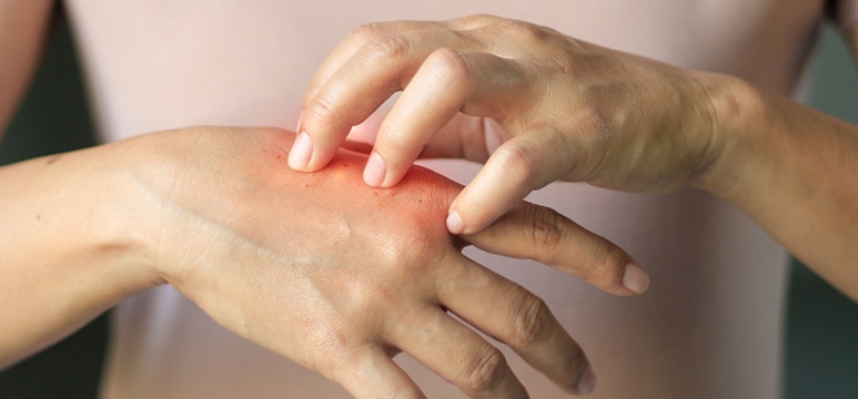 woman scratching her hands