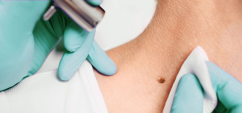 dermatologist removing mole on patient’s neck