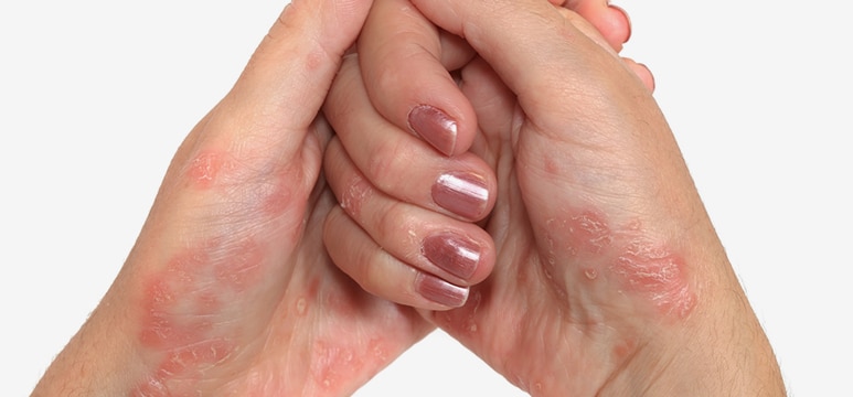 hands with psoriasis on the palms and fingers