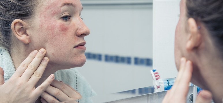 woman suffering from rosacea checking her face on the mirror