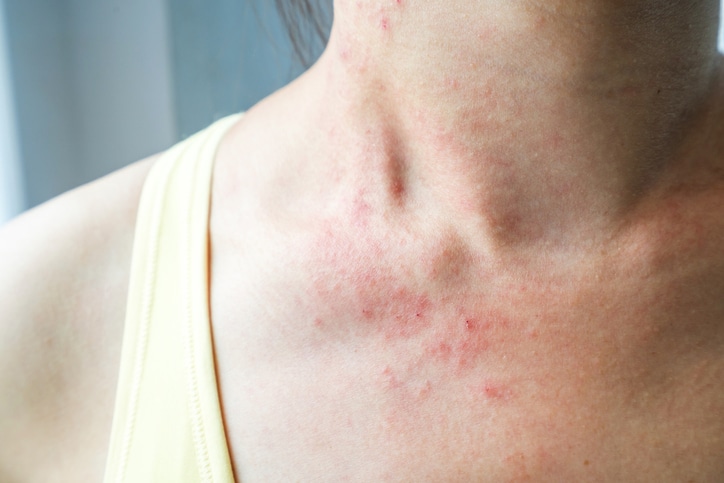 adult heat rash on neck