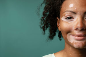 smiling young african casual woman with vitiligo condition