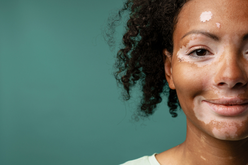 Are Your White Patches of Skin Vitiligo? Find Out - Keys Dermatology