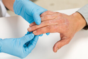 dermatologist wearing gloves examines the skin of a sick patient.