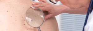 Melanoma Risks for Older Adults What You Should Know
