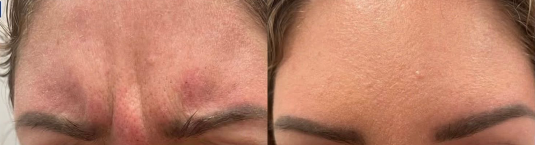 Before and After Image: Botox - front