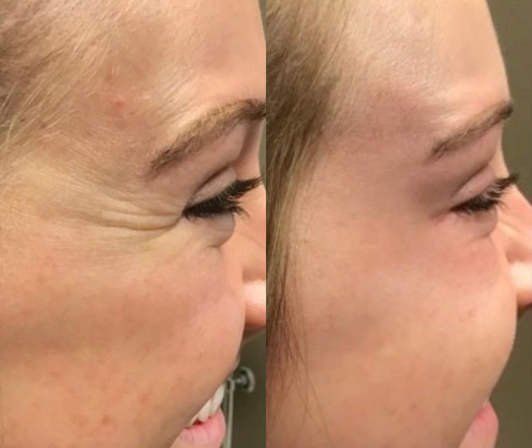 Before and After Image: Botox - right-side