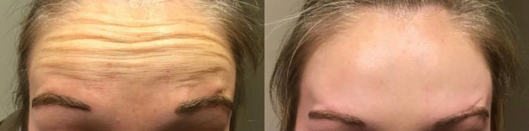 Before and After Image: Botox - front
