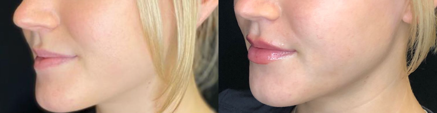 Before and After Image: Fillers - left-front-oblique
