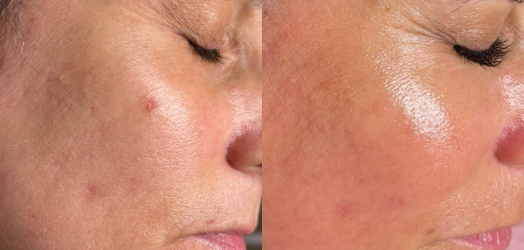 Before and After Image: Microneedling - right-front-oblique