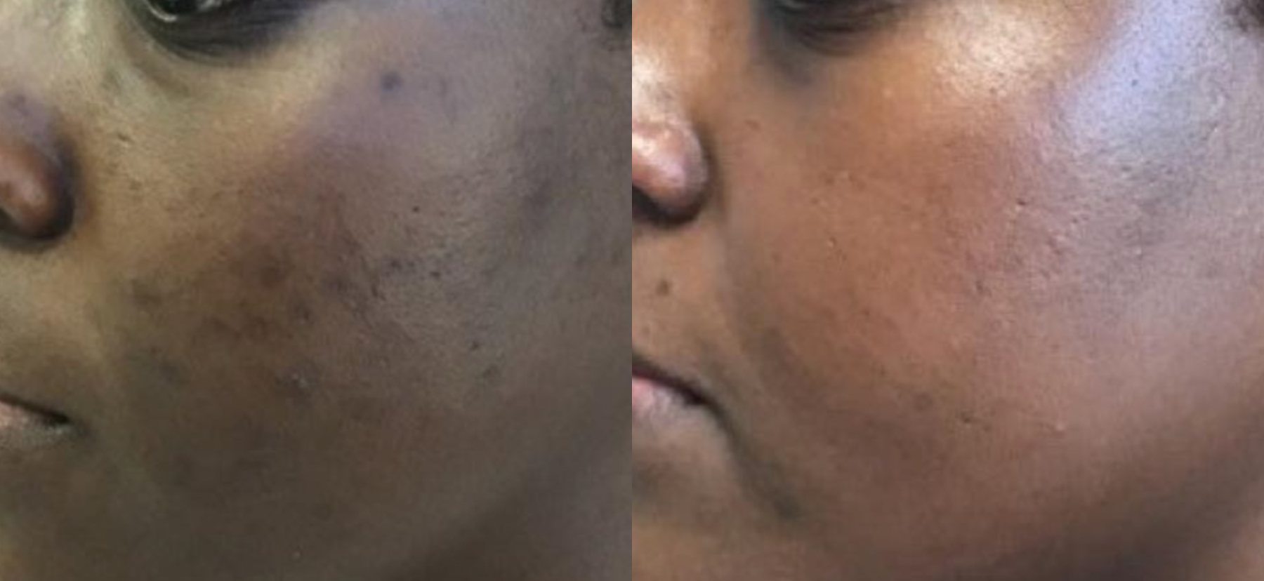 Before and After Image: Microneedling - left-front-oblique