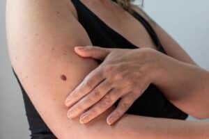 cryosurgery